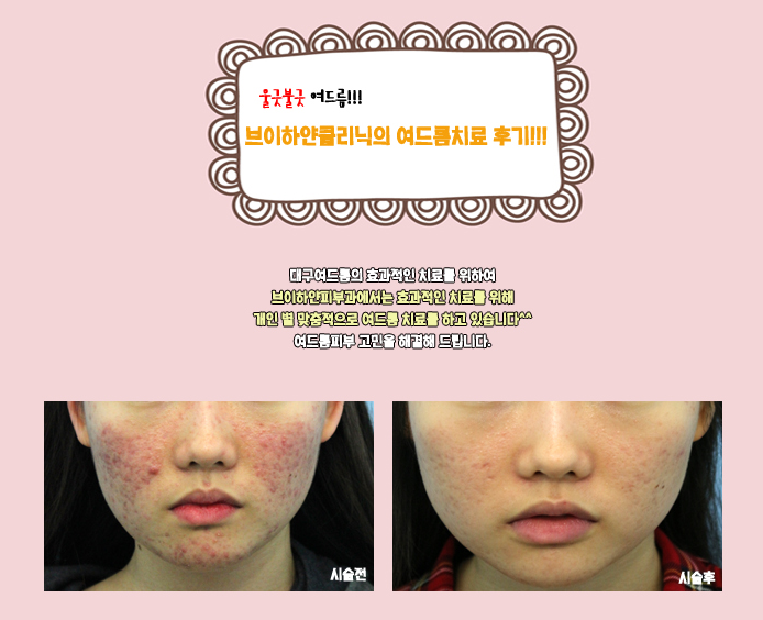여드름 치료 후기